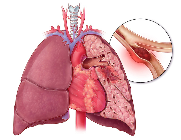 découvrez tout ce que vous devez savoir sur l'embolie pulmonaire : ses causes, symptômes, traitements et prévention. informez-vous sur cette condition grave qui affecte la circulation sanguine et apprenez comment reconnaître les signes d'alerte.