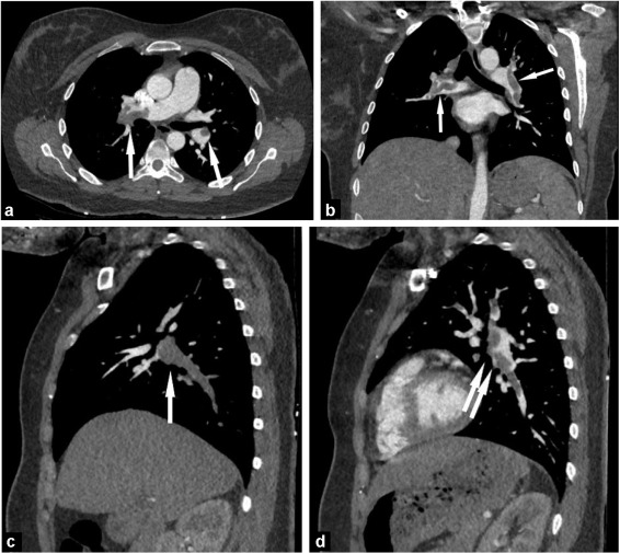 l'embolie pulmonaire est une condition médicale grave qui survient lorsque des caillots sanguins obstruent les vaisseaux pulmonaires, entraînant des douleurs thoraciques, des essoufflements et des complications potentiellement mortelles. apprenez les causes, symptômes et traitements de cette urgence médicale.
