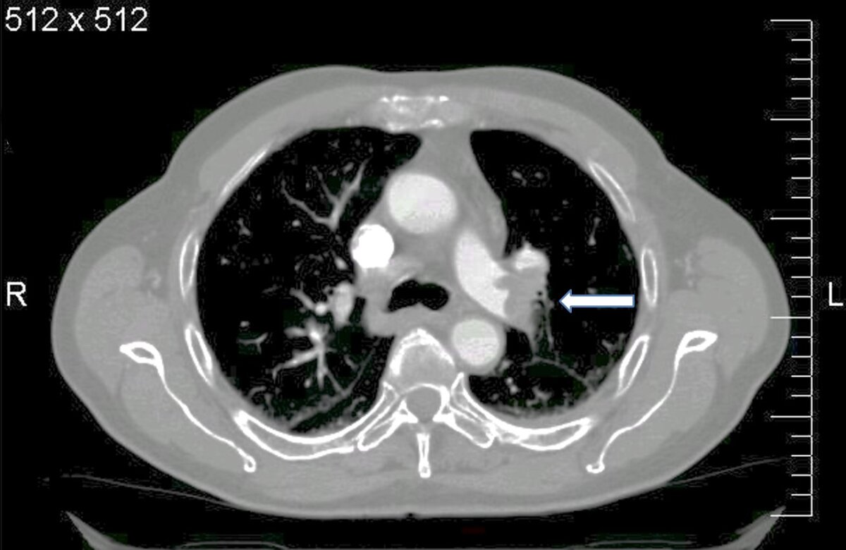 découvrez tout sur l'embolie pulmonaire : ses causes, symptômes, traitements et conseils de prévention. informez-vous sur cette affection sérieuse et apprenez comment reconnaître les signes pour agir rapidement.
